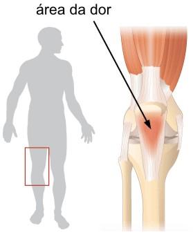 Atletas precisam ter dores na região da patela (foto: Divulgação)